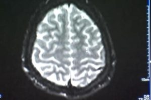 A fost identificată zona din creier afectată de autism