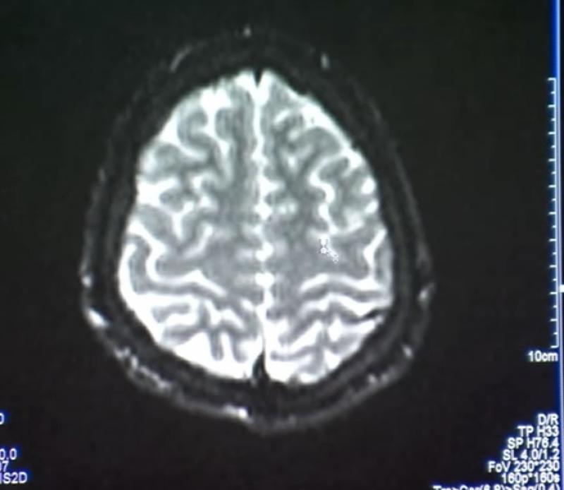 A fost identificată zona din creier afectată de autism