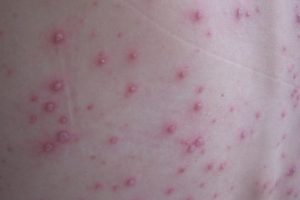 Explozie a cazurilor de varicelă în Timiș. În ultima săptămână, la Victor Babeș au fost evaluați câte 3-4 pacienți pe zi