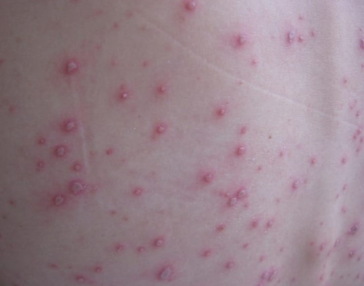 Explozie a cazurilor de varicelă în Timiș. În ultima săptămână, la Victor Babeș au fost evaluați câte 3-4 pacienți pe zi
