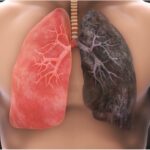 Un român moare în fiecare oră din cauza cancerului pulmonar